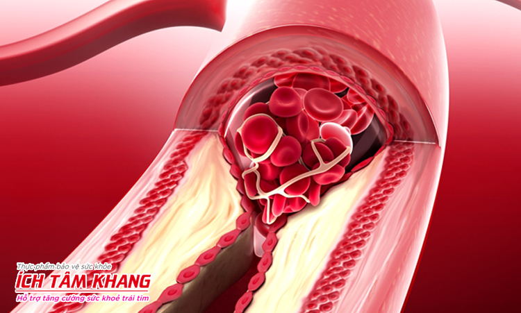 Bệnh mạch vành là nguyên nhân hàng đầu gây đau tim